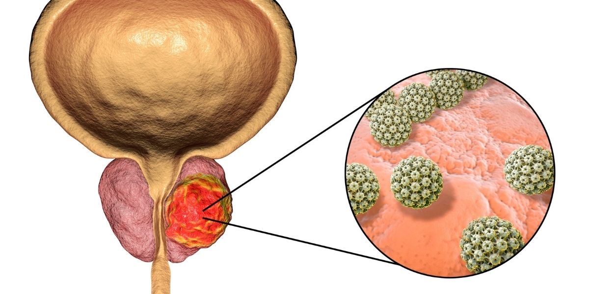 Cancerul de prostata: Simptome, Cauze, Tratament - transportbucurestinonstop.ro