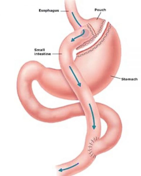bypass-gastric
