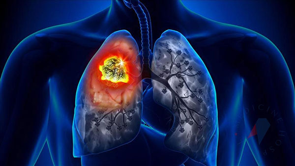 Cancerului-Pulmonar